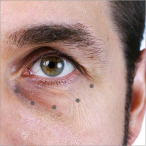tear trough injection areas dark eye circles treatment