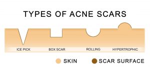 acne scars types