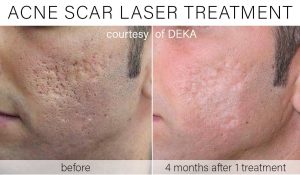 acne scarring laser